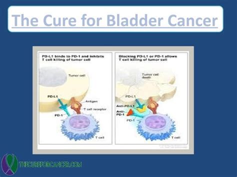 The cure for Bladder Cancer | treatment of Bladder Cancer by The Cure for Cancer - Issuu