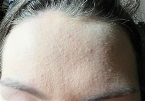 [Acne] Any advice to help with these awful bumps? : SkincareAddiction | Acne, Sunscreen ...