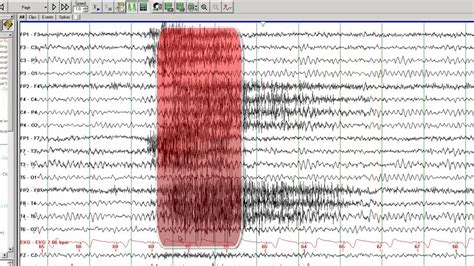 Eeg test for absence seizures