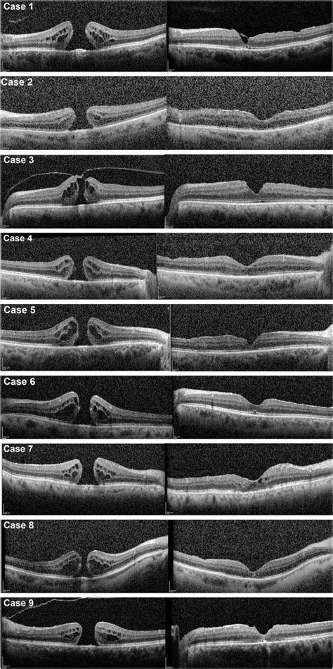 Sd Oct Scans Of The Preoperative Appearance And The Postoperative