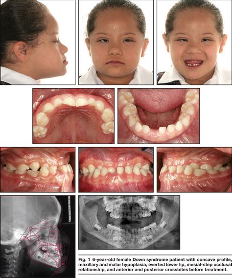 Figure 1 From Modified Alt RAMEC Treatment Of Class III Malocclusion In