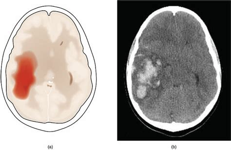 Hemorragia Intracerebral Concise Medical Knowledge