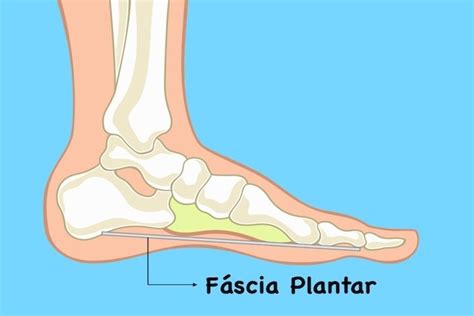 Fascite Plantar O Que é Sintomas Causas E Tratamento Tua Saúde