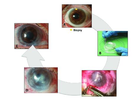 Different Steps Of A Cultivated Limbal Stem Cell Transplantation A