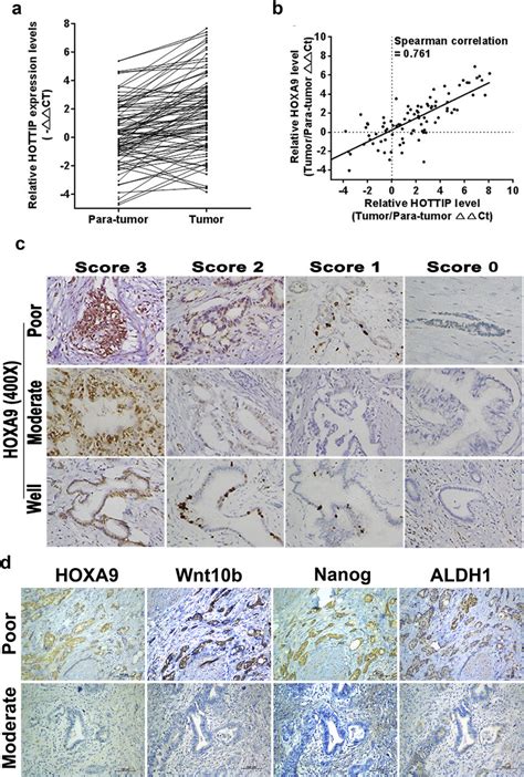 Hottip Expression Correlated With Prognosis Hoxa Level And Csc