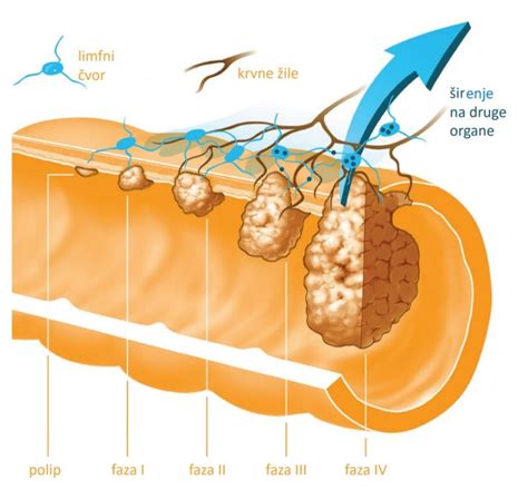 Rak Debelog Crijeva Simptomi Uzroci I Lije Enje Telegram Hr