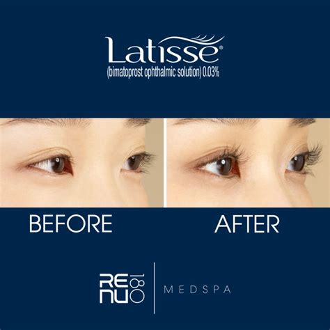 Latisse Eyelash Growth Serum Vs Eyelash Extensions Renu 180