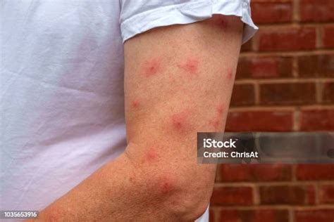 Allergic Reaction To Mosquito Bites Stock Photo Download Image Now