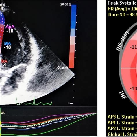 An Example Of Right Ventricular Strain Speckle Tracking Apical Four