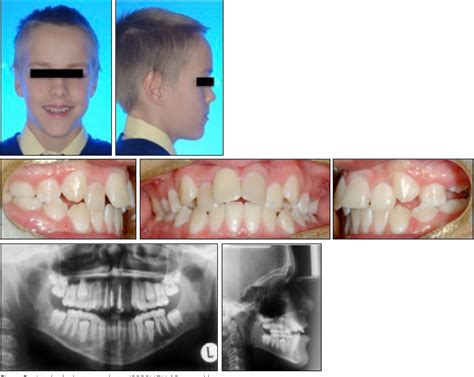 Figure 2 From Single Tooth Osteotomy And Distraction In The Treatment Of An Ankylosed Central