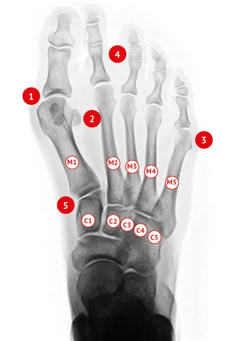 Hallux valgus Orthopädie Zentrum Arabellapark München