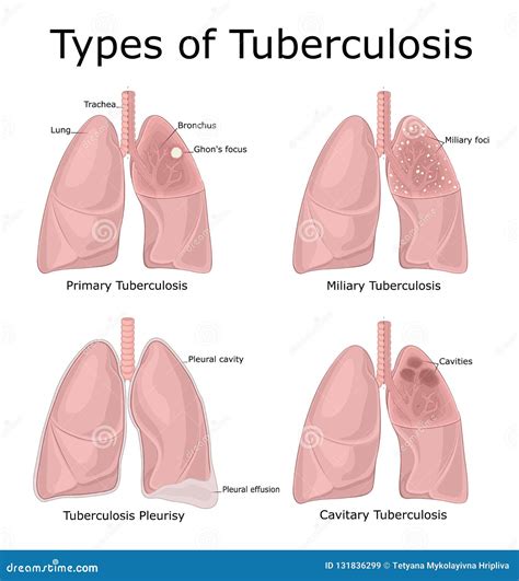 Types Of Tuberculosis Stock Vector Illustration Of Lesion