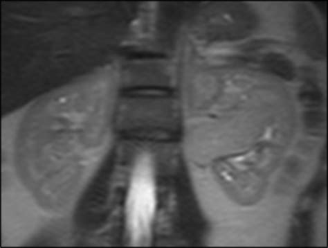 Renal Angiomyolipoma Extending To Inferior Vena Cava Eurorad