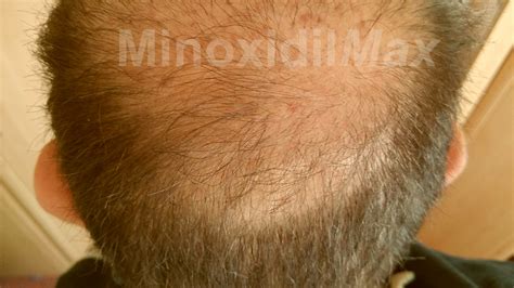 Minoxidil Results Before After Amazing Pictures