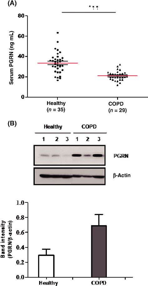 Expression Of Progranulin Pgrn In Sera And Peripheral Blood