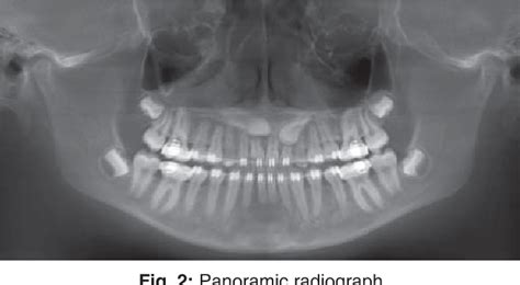 Figure 2 From Root Resorption Of Maxillary Incisors Caused By