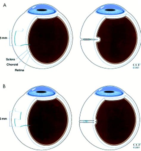 Limited Macular Translocation With Scleral Retraction Suture British