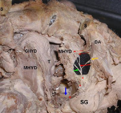 The Topography And Branching Of The Mylohyoid Nerve The Blue Arrow