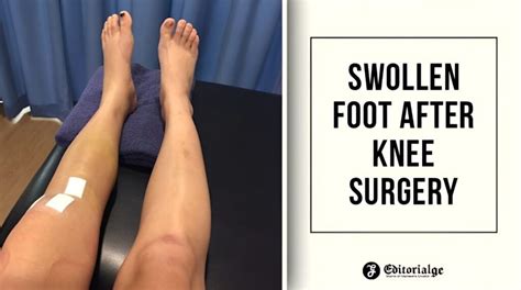 Swollen Foot After Knee Surgery Causes Symptoms And Treatment