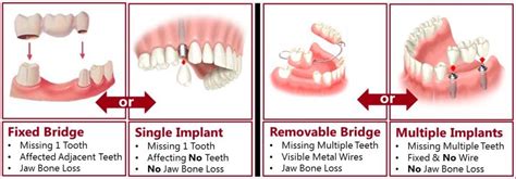 Dental Bridges Chester Springs PA | Replace Teeth