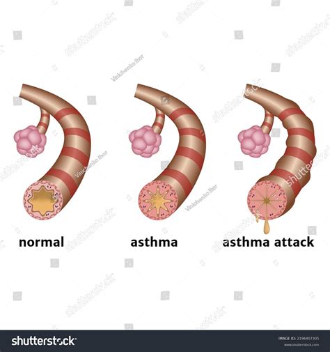 Bronchial Asthma Chronic Inflammation Lower Respiratory Stock Vector ...