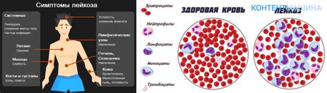 Заболевание крови симптомы у взрослых и лечение рак крови лейкоз