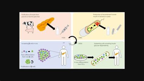 Advances in insulin therapy from discovery to β cell replacement