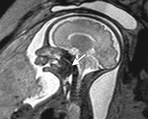 Exit Procedure Technique And Indications With Prenatal Imaging