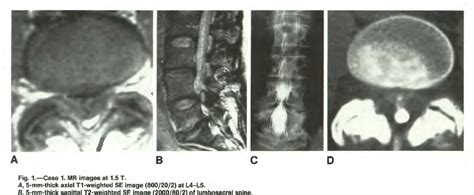 Synovial Cyst Semantic Scholar