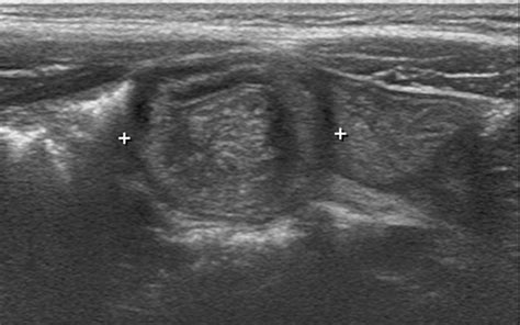 Acute Appendicitis On Ultrasound