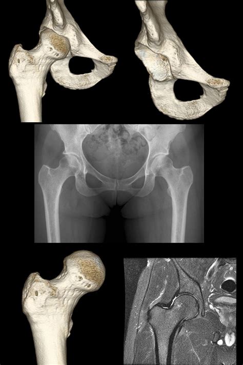 A Radiologia Do Quadril O Quadril Especialista Em Cirurgia Do