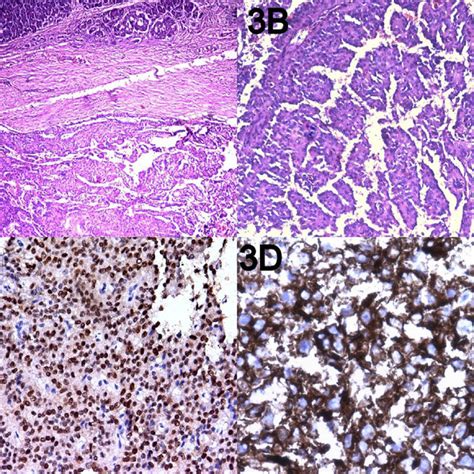 Aandb On Microscopy A Well Circumscribed Tumor Mass Separated From