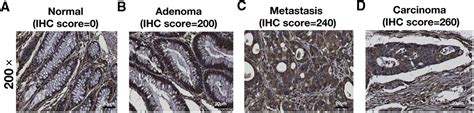 Oncologie Free Full Text Rcn Expression Indicates Prognosis In