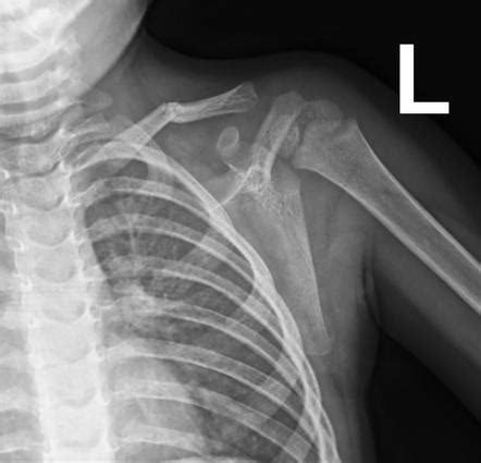 Clavicle Fracture Radiology Case Radiopaedia Org