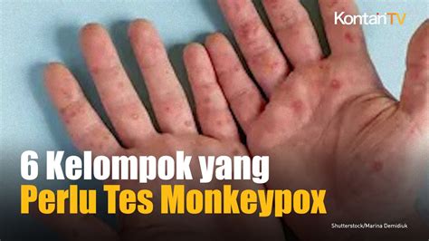 Kasus Bertambah Jadi Ini Kelompok Orang Yang Perlu Tes Cacar