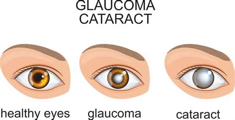 Cataract Straar Wat Is Het Precies Oogaandoeningen Nl