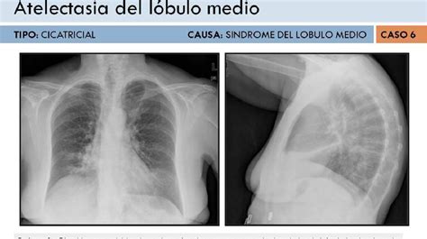 Revisión De Los Signos Radiológicos De Atelectasia Pulmonar Hallazgos