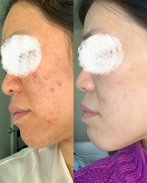 Dpc Laser Acne Treatments Vertex Aesthetics