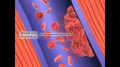 Formation Of Deep Vein Thrombosis Youtube