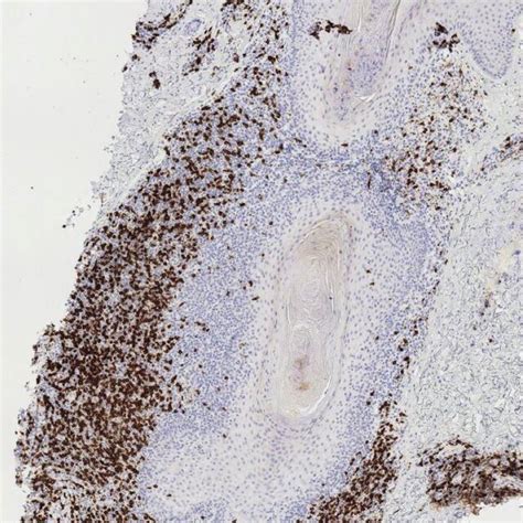 Perifollicular CD8 T Cells In A CD4 Predominant Folliculotropic Mycosis