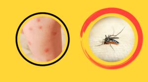 West Nile Virus Rash | Symptoms | Diagnosis | Best Treatment