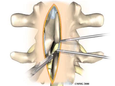 Lumbar Laminectomy With Fusion