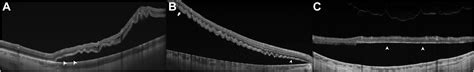 Morphologic Stages Of Rhegmatogenous Retinal Detachment Assessed Using