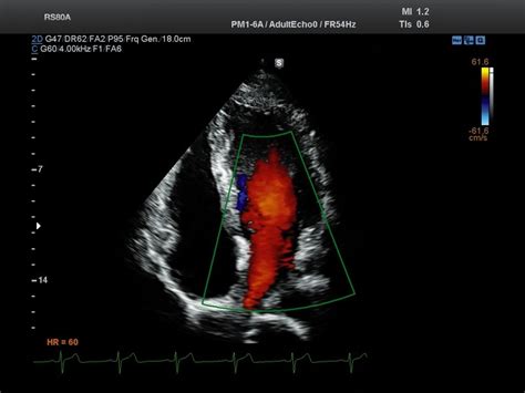 Ultrasound Images • Heart Apical 4 Chamber View Color Doppler Echogramm №689