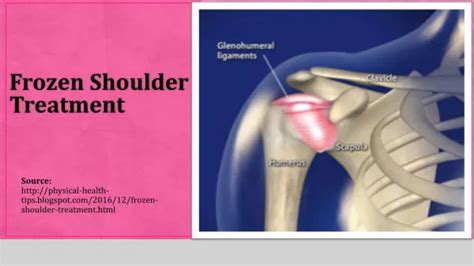 Ppt Unlocking Mobility The Best Frozen Shoulder Treatment With