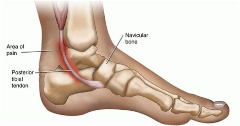 Denton Orthopedic Ankle Impingement Syndrome Causes Symptoms And