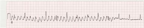 22 Ventricular Dysrhythmias Flashcards Quizlet