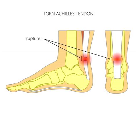 Achilles Tendonitis And Plantar Fasciitis Premier Podiatry Velimir