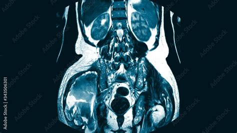 Magnetic Resonance Imaging Mri Of Both Hip Sagittal Plane Finding A