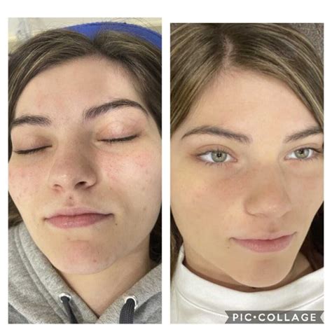 Before After Facials Xpress And Body Sculpt